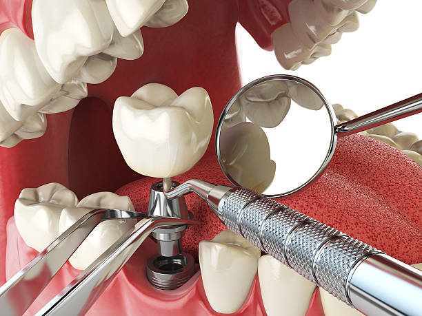 Best Broken or Cracked Tooth Emergency Dentist in Scottsville, NY